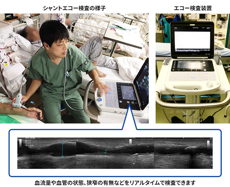 シャントエコー検査のイメージ